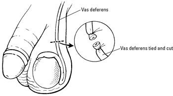 ���� - Control de la natalidad: cómo funciona una vasectomía