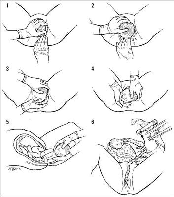 Examen Emt: cómo realizar un parto normal