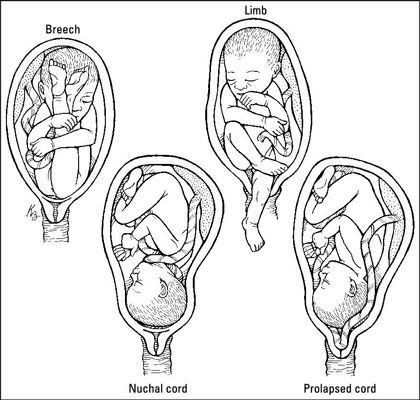 Examen Emt: cómo realizar un parto anormal