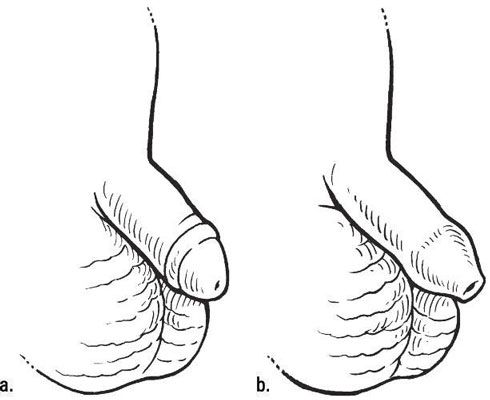 Un pene circuncidado (a) y un pene no circuncidado (b). [Crédito: Ilustración por Kathryn Born, MA]