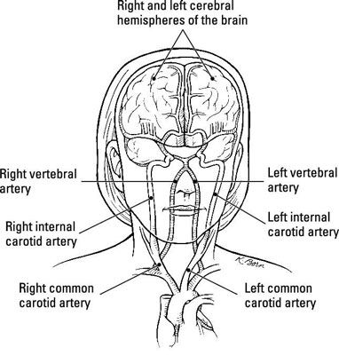 ���� - Accidente cerebrovascular, también conocido como a & # 147-ataque cerebral & # 148-